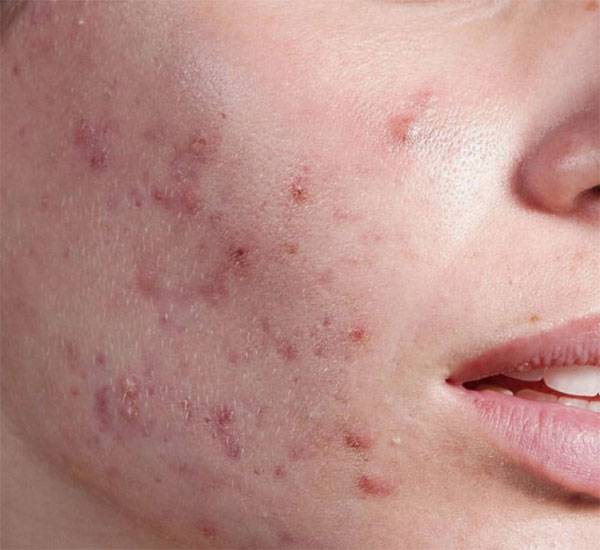 Blemiderm